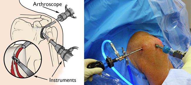 Arthroscopy