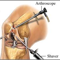 Arthroscopy