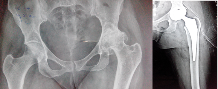  Joint Replacement