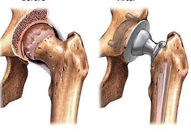  Joint Replacement