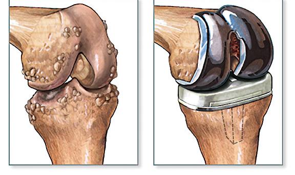  Joint Replacement