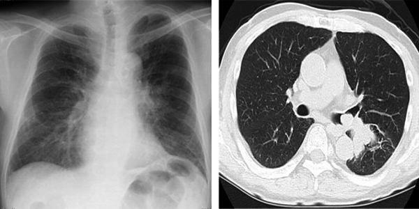 Pulmonology Viral Hospital