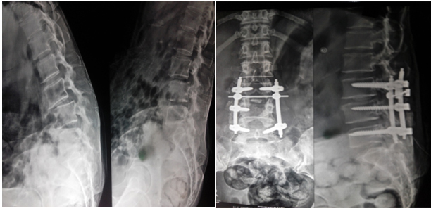 Spine Surgery