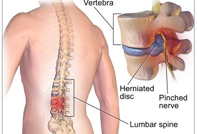 Spine Surgery